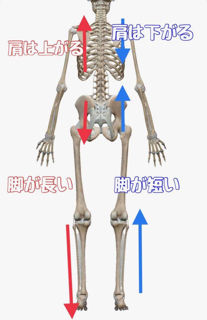 左足が長いのは骨盤が下がっているからです